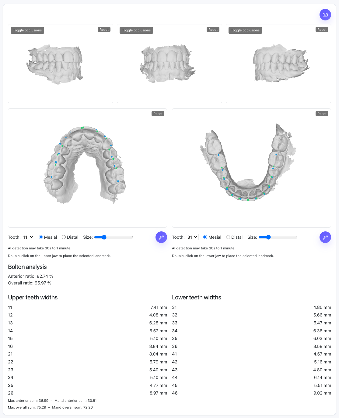 Bolton tooth-size analysis preview